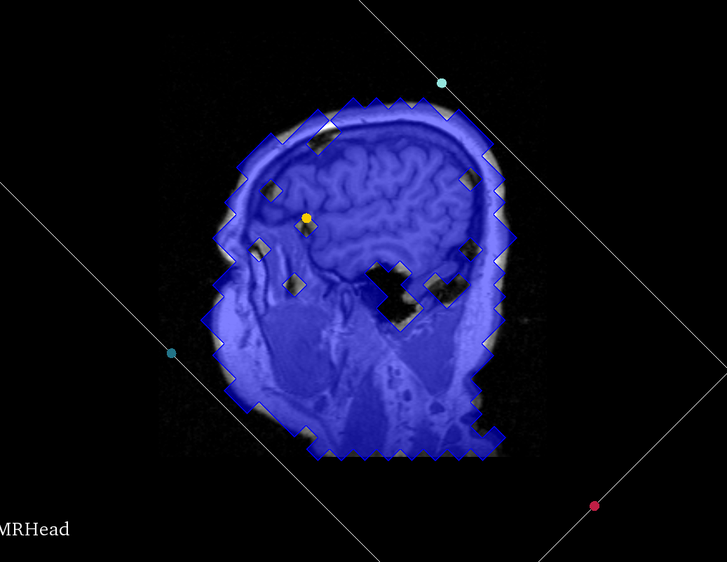 MRHead threshold resampled with oblique ROI into low resolution